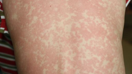 BREAKING: Measles alert issued for the Gold Coast