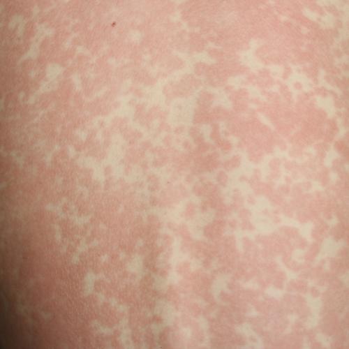 Fresh measles alert for Gold Coast after two confirmed cases