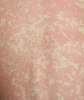 Measles alert issued after infectious person attends popular Gold Coast event