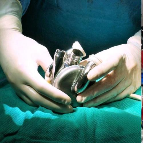 Aussie Man Lives Over 100 Days with New Titanium Heart